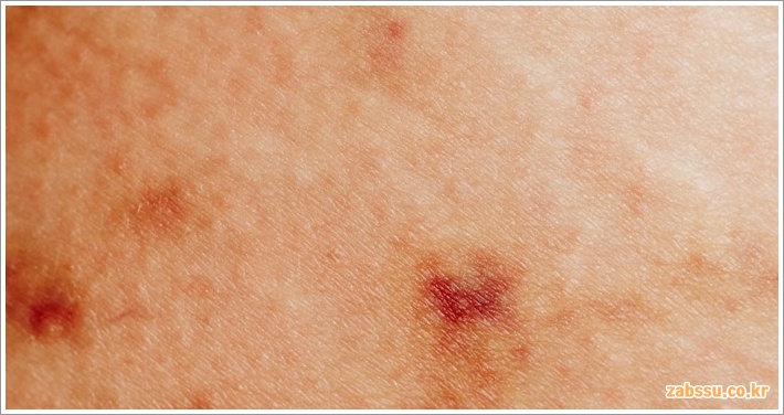 습진 증상 원인 치료 방법과 효과적인 관리법 안내 습진 증상 원인 치료 방법과 효과적인 관리법 안내